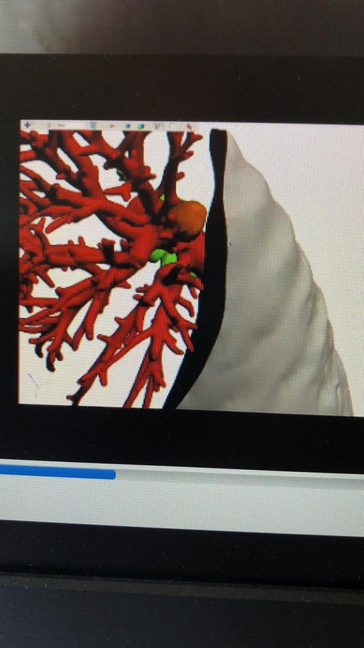 Intervento chirurgico innovativo per l’asportazione di un tumore polmonare