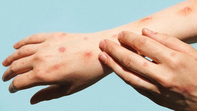 Vaiolo delle scimmie: le indicazioni della Regione Piemonte