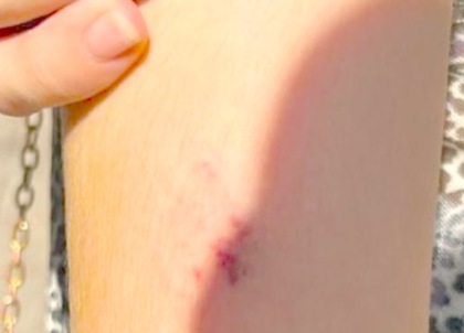 Morsicata da un cane in pieno centro cittadino